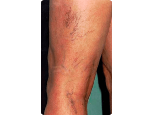 varicose veins 1